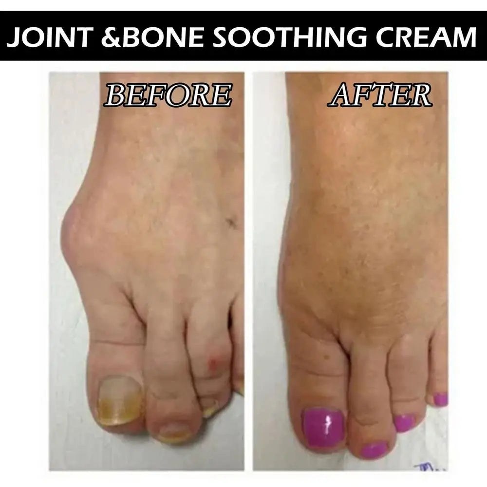 Joint Bone Counterpain Cream Joint Bone Discomfort Relief Cream Orthopedic Valgus Corrector Knee Muscle Treat Ointments